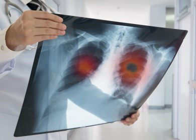 The health issues that could be an early sign of lung cancer