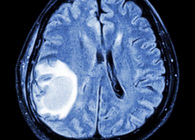 Cancer and tumour aren’t the same thing. Here’s the difference